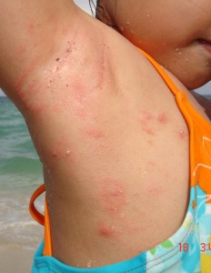 Armpit Acne