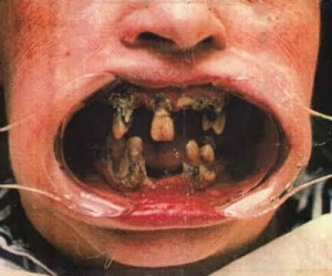 Teeth Decay Teeth Decay